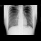 Pneumothorax: X-ray - Plain radiograph